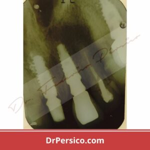 hueso oseointegración implantes dentales