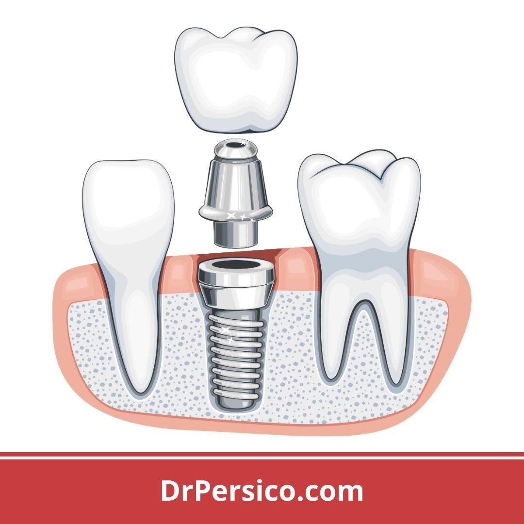 planificacnón tratamiento con implantes dentales