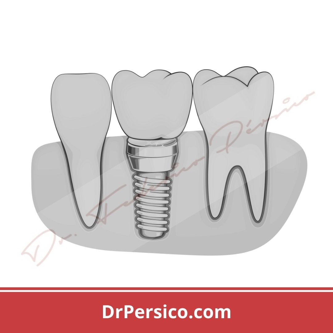 oseointegración implantes dentales